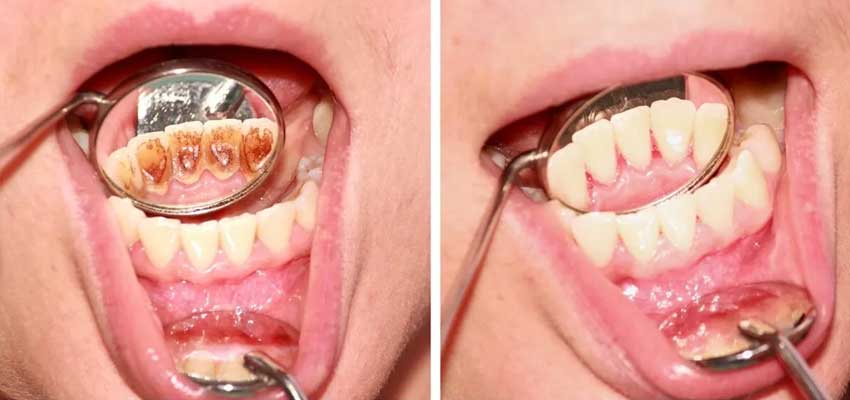 plaque and tartar in teeth