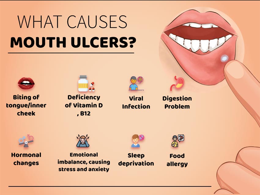 causes of mouth ulcers