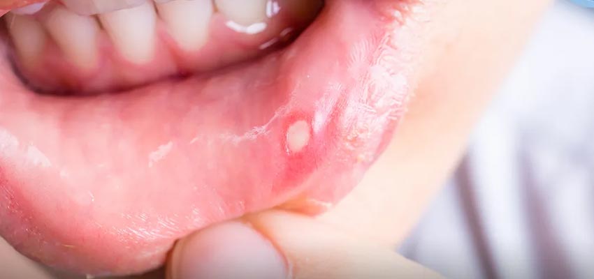 mouth ulcer medicine in india