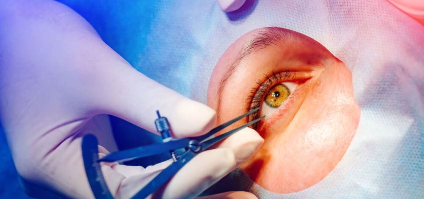 lasik surgery