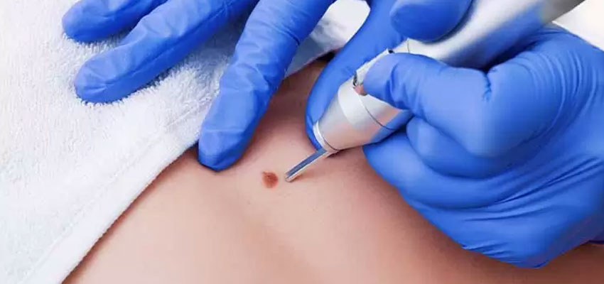 mole removal procedure cost in india