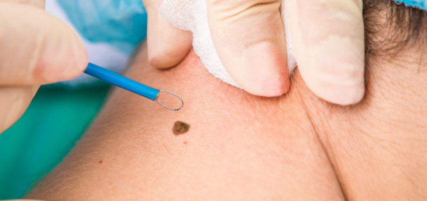 mole removal surgery in india