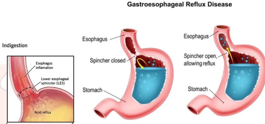 reason for gastric