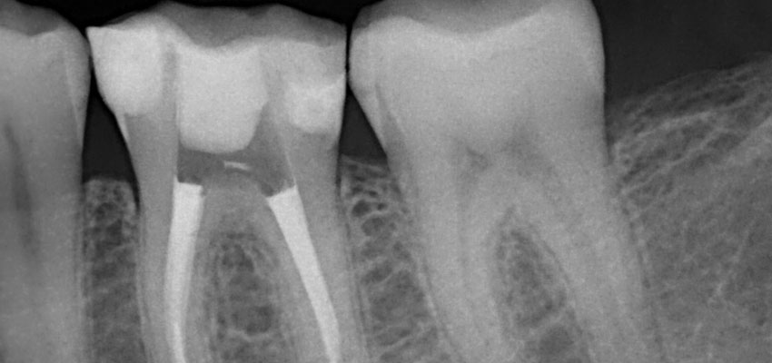 before and after photo of root canal or rct treatment