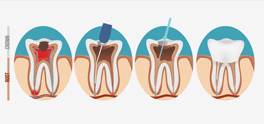 root canal treatment steps in india