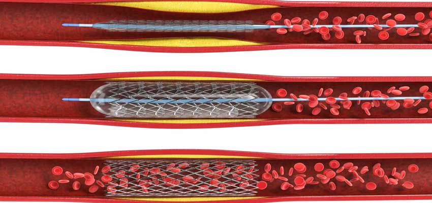 angioplasty side effects success rate