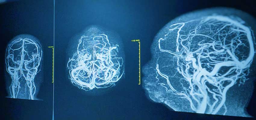 brain angiogram definition