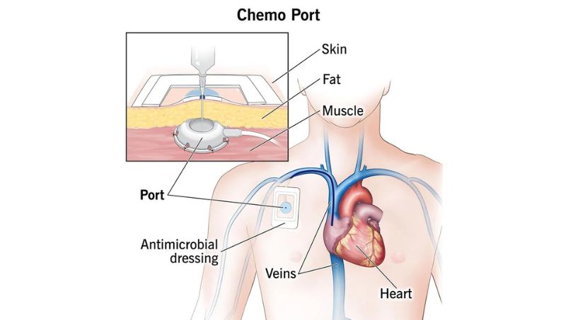 _chemotherapy port