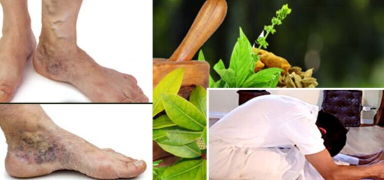 Gattumal Ayurveda Varicose Veins Pain Relief Oil main image 0