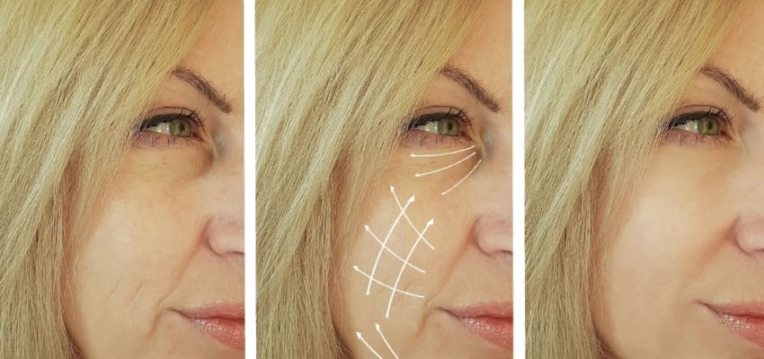 Pros of Anti-Wrinkle and Skin Tightening Treatments