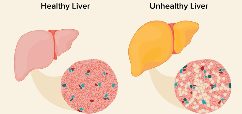 Factors that lead to fatty liver disease