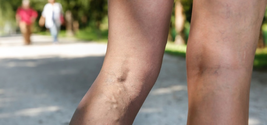 Prognosis of Deep Vein Thrombosis