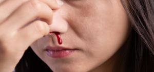 नाक से बहते खून को रोकने के उपाय