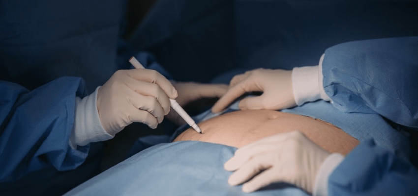 Hipec-Surgery-Prognosis