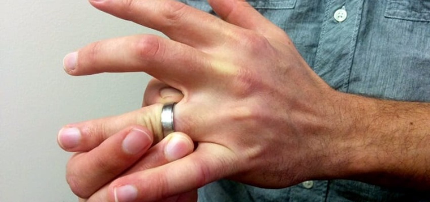 How-ring-avulsions-affect-the-finger