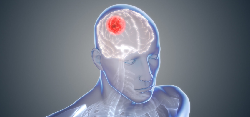 Introduction-Glioblastoma-Treatment