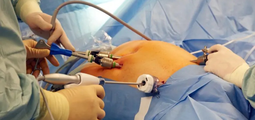 Treatment-of-Hipec-Surgery