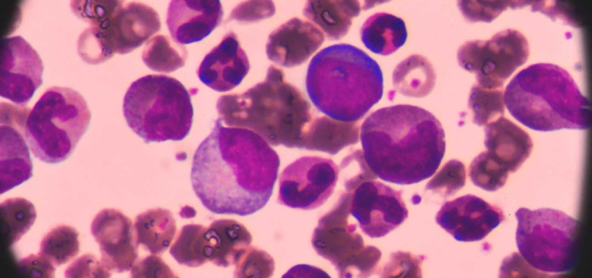 Diagnosis of acute myeloid leukemia
