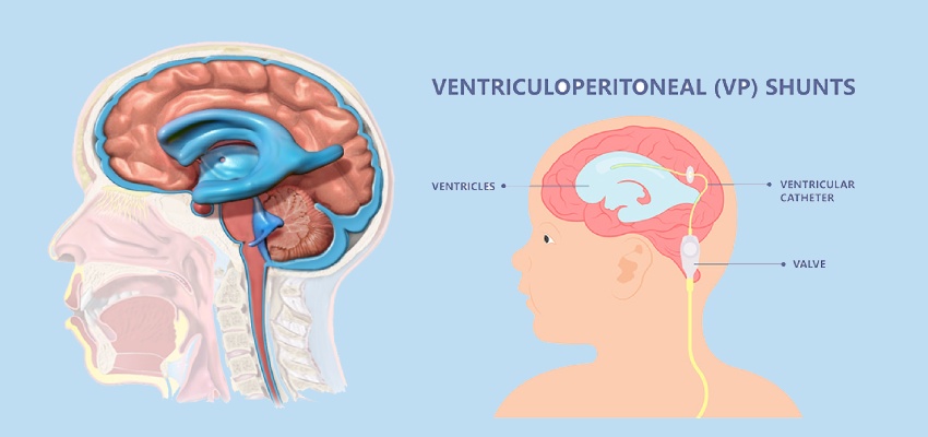 Introduction Hydrocephalus Treatments