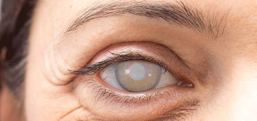Side effects of cataract surgery