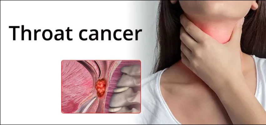 About Throat Cancer