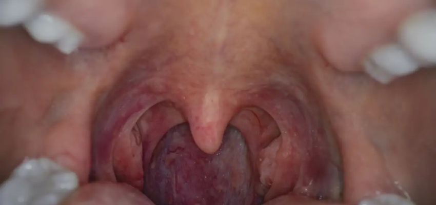 Prognosis of throat cancer
