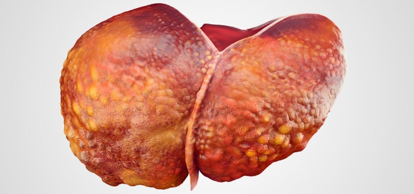 Signs and Symptoms of Fatty Liver