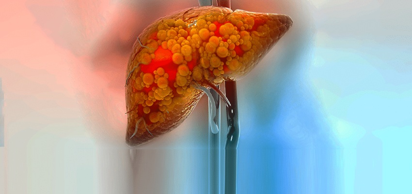 Some risk Factors of Fatty Liver