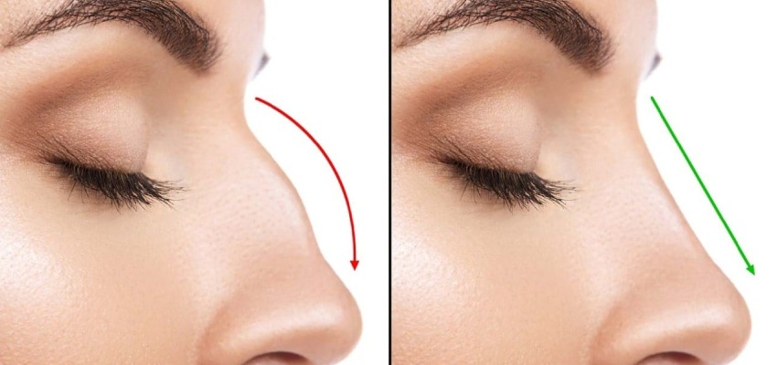 The Cost of Rhinoplasty in Bangalore