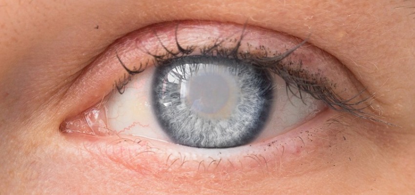 Symptoms of cataract