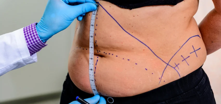 Cost price of Liposuction surgery in Delhi