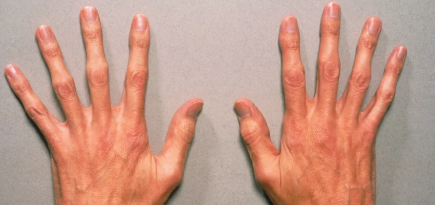 Introduction of Marfan Syndrome Treatment