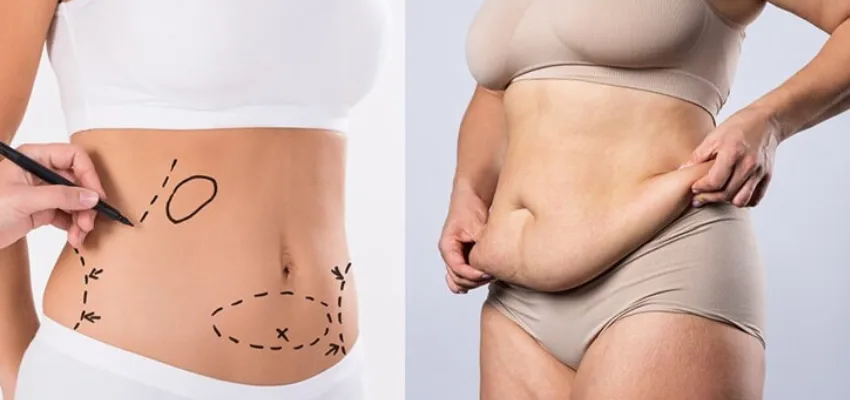 Why do people need liposuction surgery