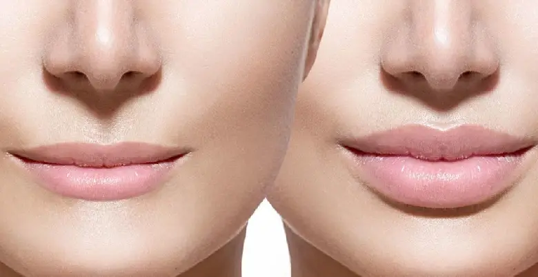 Lip reduction surgery benefits