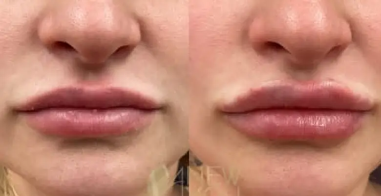 lip reduction surgery treatment